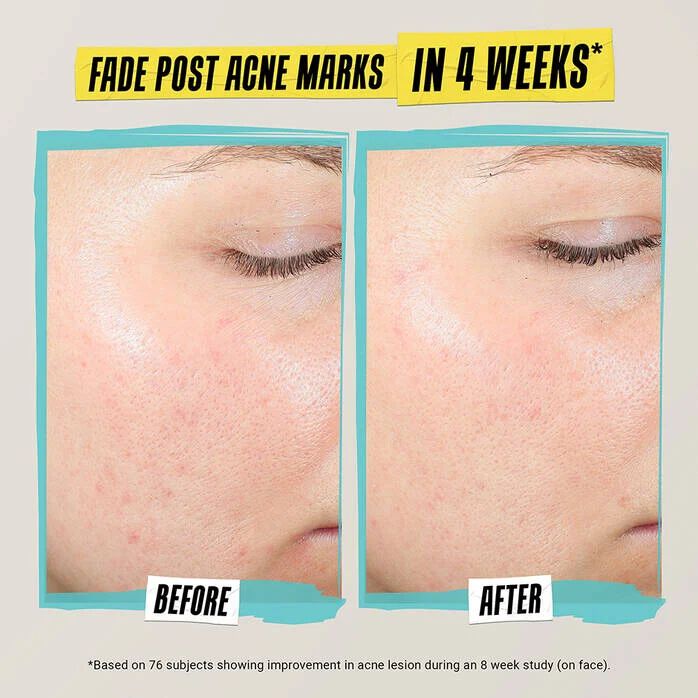 Kem Dưỡng Ngăn Ngừa Mụn Expertly Clear Blemish - Treating