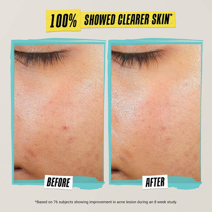 Kem Dưỡng Ngăn Ngừa Mụn Expertly Clear Blemish - Treating