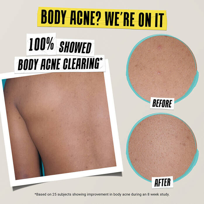 Kem Dưỡng Ngăn Ngừa Mụn Expertly Clear Blemish - Treating