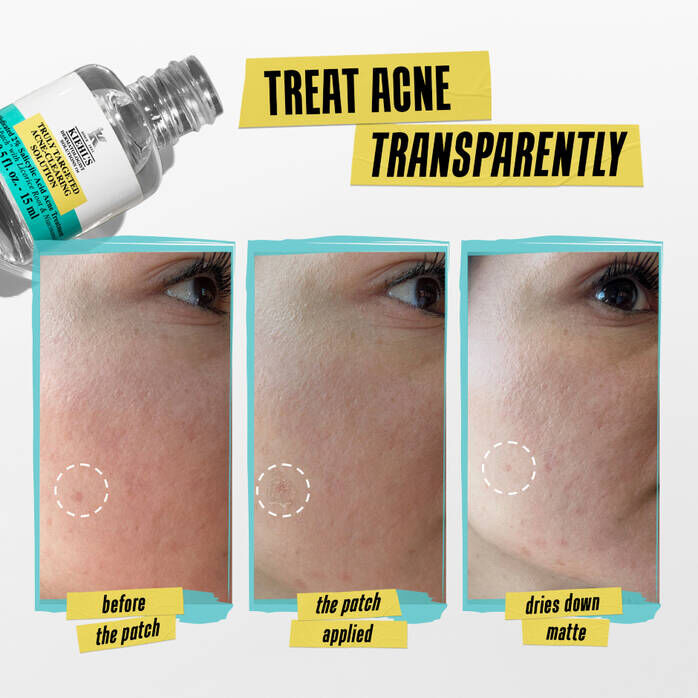Serum Chấm Mụn 2 Trong 1 Kiehl’s Truly Targeted Blemish-Clearing Solution