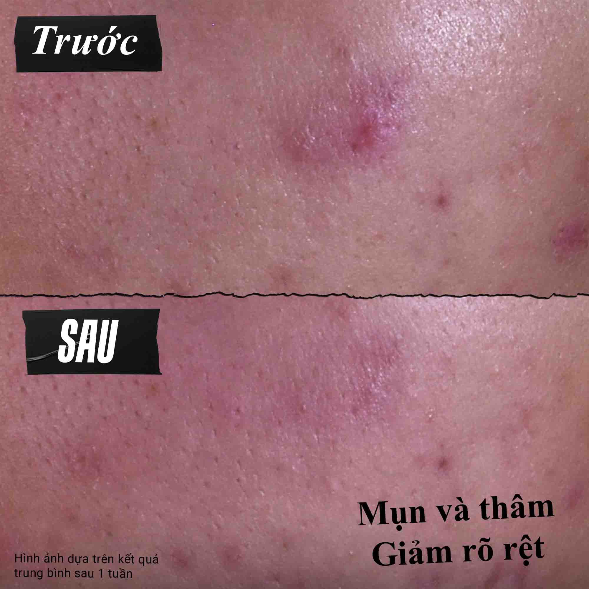 Results of using Gently Effective Blemish-Treating Cleansing Paste​