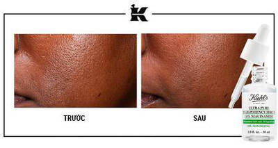 Before and After Retinol Serum