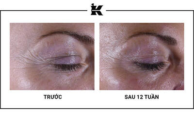 Before and After Super Multi-Corrective Eye Zone Treatment