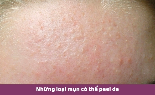 Da đang mụn có peel được không? Những trường hợp da mụn vẫn peel da được