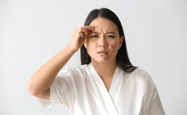 Liệu pháp miễn dịch trong trường hợp mụn dị ứng nặng