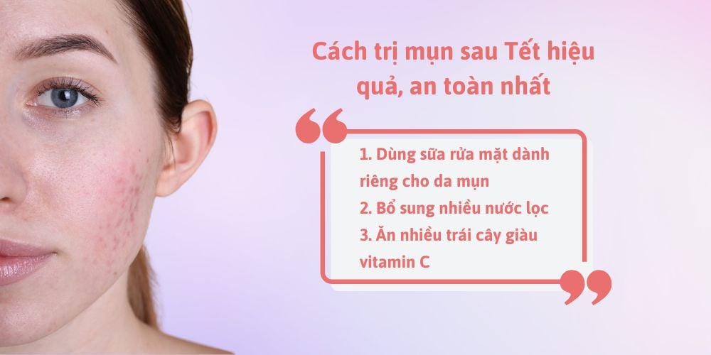 Cách trị mụn sau Tết hiệu quả, an toàn nhất