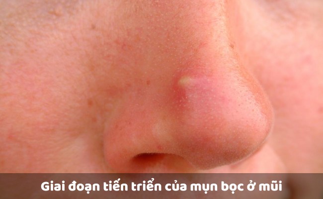 Giai đoạn tiến triển của mụn bọc ở mũi