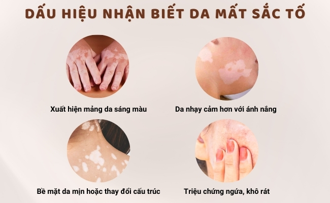 Dấu hiệu nhận biết da mất sắc tố là qua những lốm đốm trắng hoặc mảng da trắng