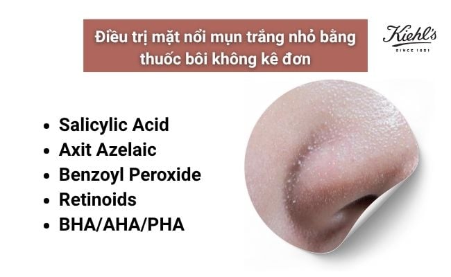 Cách điều trị tình trạng mặt nổi mụn trắng nhỏ
