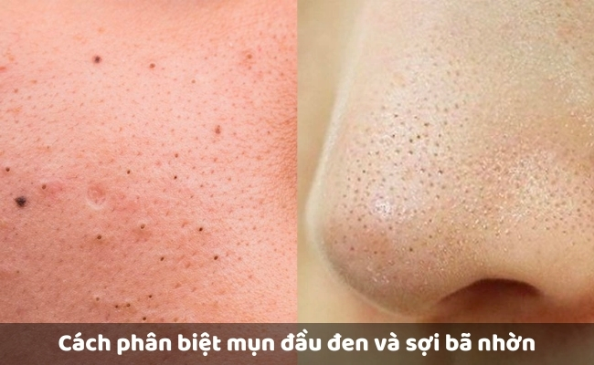 Cách phân biệt mụn đầu đen và sợi bã nhờn