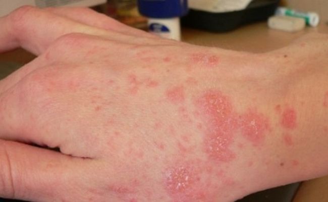 Các mảng viêm lan rộng khiến người bệnh ngứa nhiều