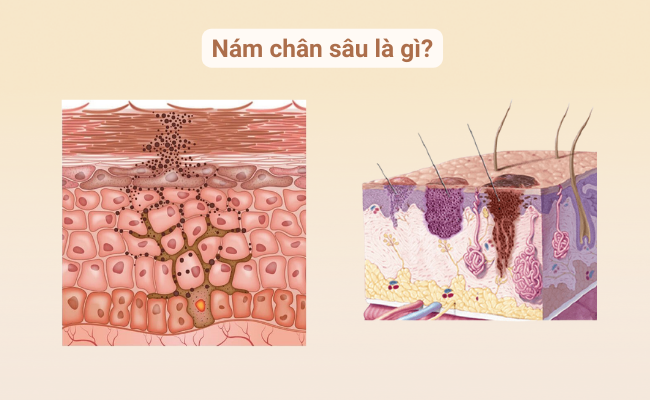 Hình ảnh mô phỏng cấu trúc da bị nám chân sâu, nơi các hắc sắc tố nằm sâu dưới lớp trung bì.