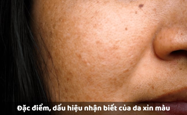 Đặc điểm, dấu hiệu nhận biết của da xỉn màu