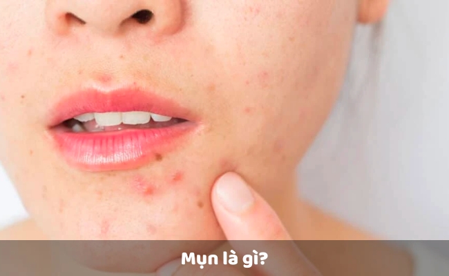 Da Mặt Đột Nhiên Nổi Nhiều Mụn Do Đâu?