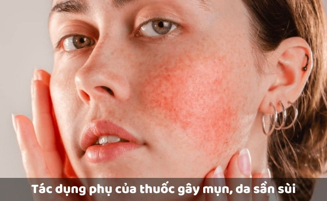 Tác dụng phụ của thuốc gây mụn, da sần sùi