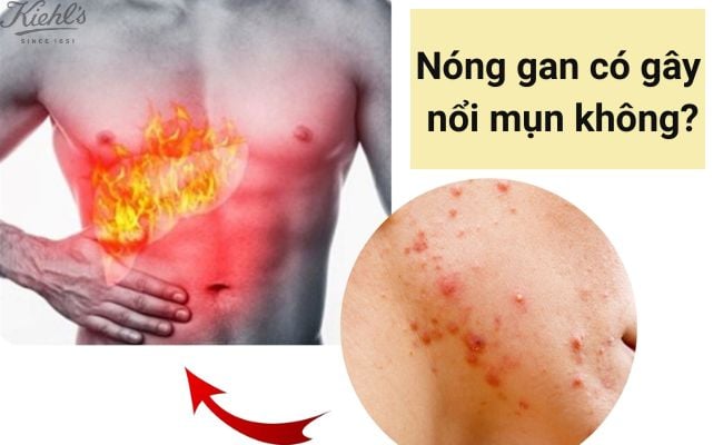 Nóng gan có gây nổi mụn không?