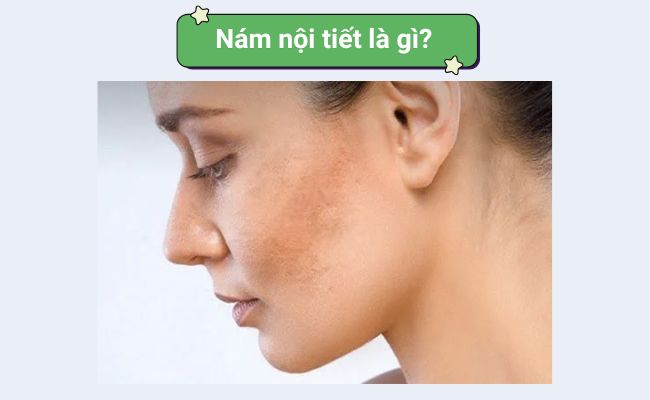 Nám nội tiết là gì?