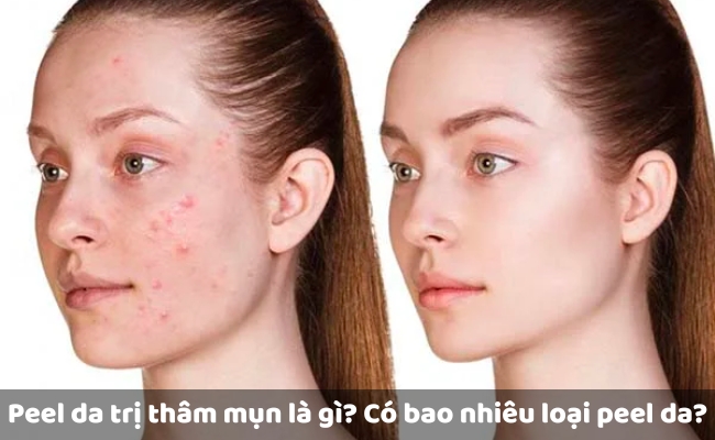 Peel da trị thâm mụn là gì? Có bao nhiêu loại peel da?