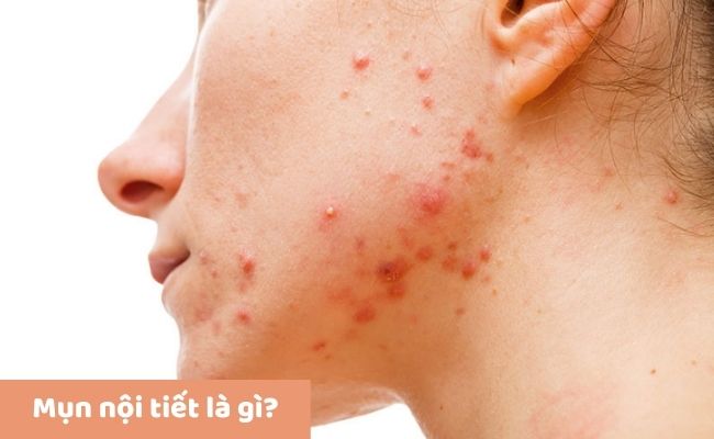 Mụn nội tiết là gì?