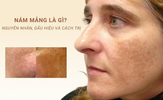 Nám Mảng Là Gì? Nguyên Nhân, Dấu hiệu Và Cách Trị Nám Mảng |