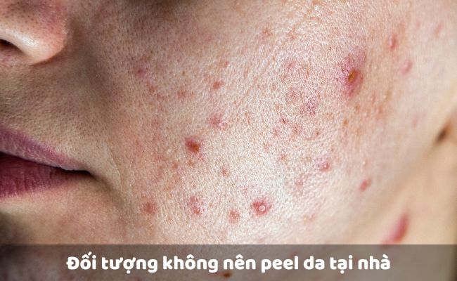 Đối tượng không nên peel da tại nhà