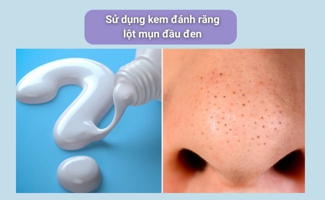 Cách lột mụn đầu đen tại nhà đơn giản, hiệu quả