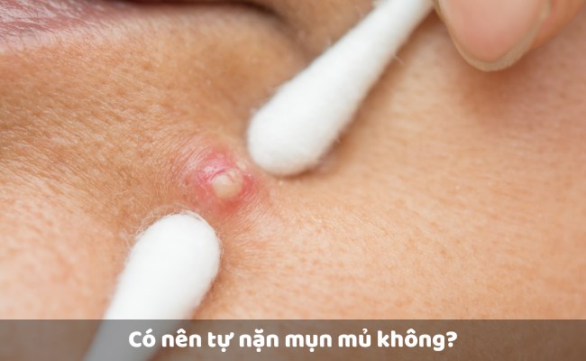 Có nên tự nặn mụn mủ không?