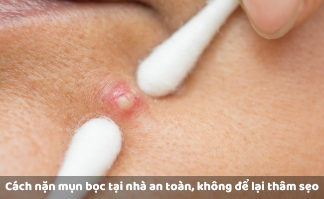 Cách nặn mụn bọc có mủ, sưng to tại nhà an toàn, không để lại thâm sẹo