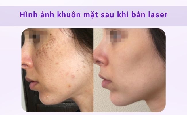 Khuôn mặt sau khi bắn laser