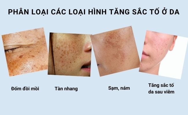 Phân loại các loại hình tăng sắc tố ở da