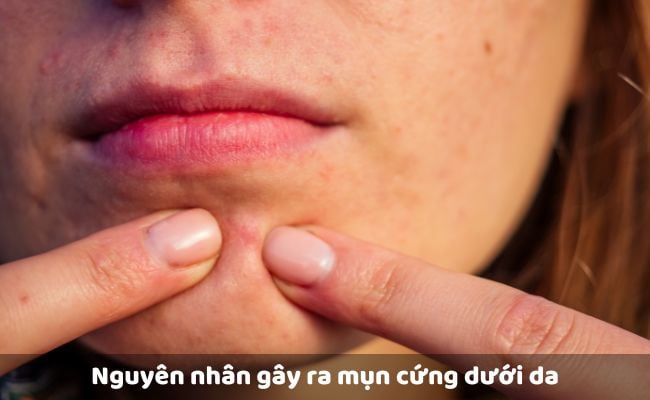 Nguyên nhân gây ra mụn cứng dưới da