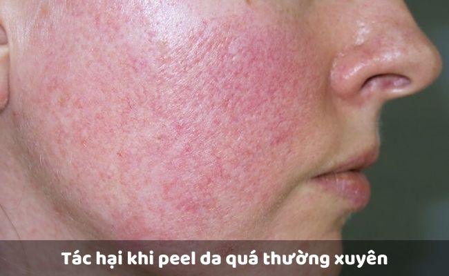 Tác hại khi peel da quá thường xuyên