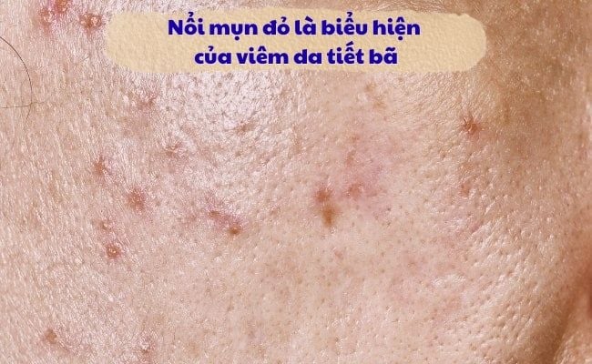 Nổi mụn đỏ trên da là biểu hiện của viêm da tiết bã
