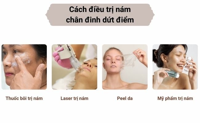 Cách điều trị nám chân đinh dứt điểm