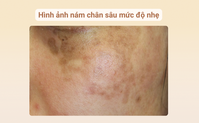 Nám chân sâu bị nhẹ