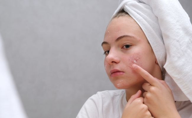 Một số lưu ý khi sử dụng thuốc chấm mụn