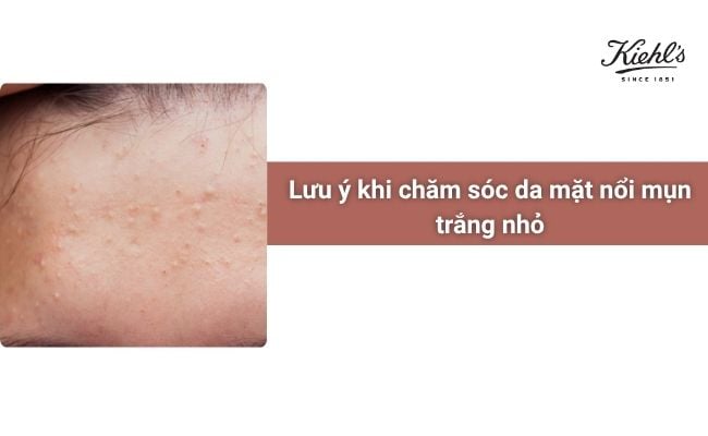 Lưu ý khi chăm sóc da mặt nổi mụn trắng nhỏ
