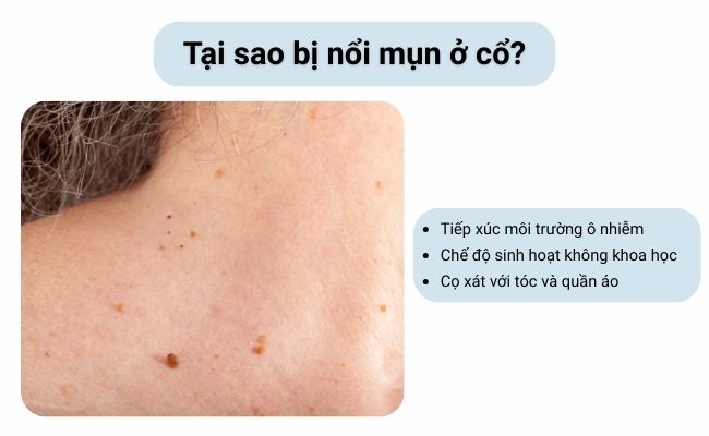 Hiểu rõ nguyên nhân gây mụn ở cổ sẽ giúp bạn điều chỉnh thói quen và tìm phương pháp điều trị phù hợp.