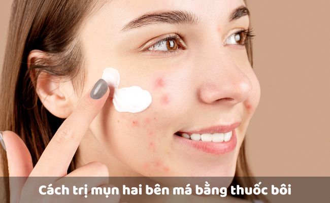 Cách trị mụn hai bên má bằng thuốc bôi

