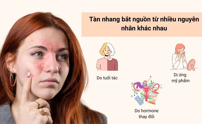 Nguyên nhân bị tàn nhang