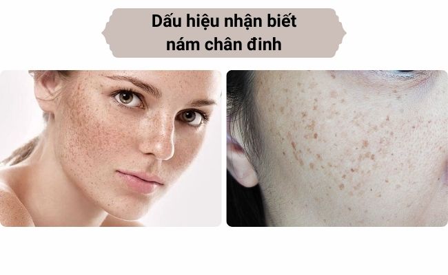 Dấu hiệu nhận biết nám chân đinh