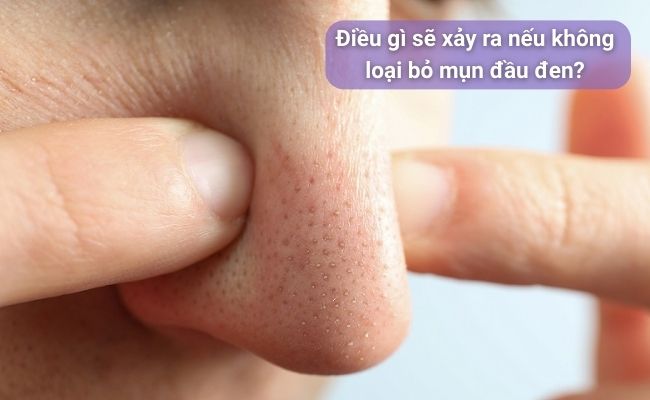 Điều gì sẽ xảy ra nếu không loại bỏ mụn đầu đen?