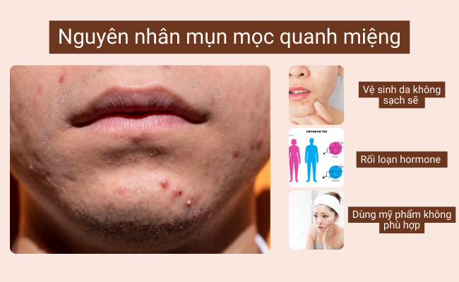 Bị mụn mọc quanh miệng do vệ sinh da, rối loạn hormone và dùng mỹ phẩm không phù hợp