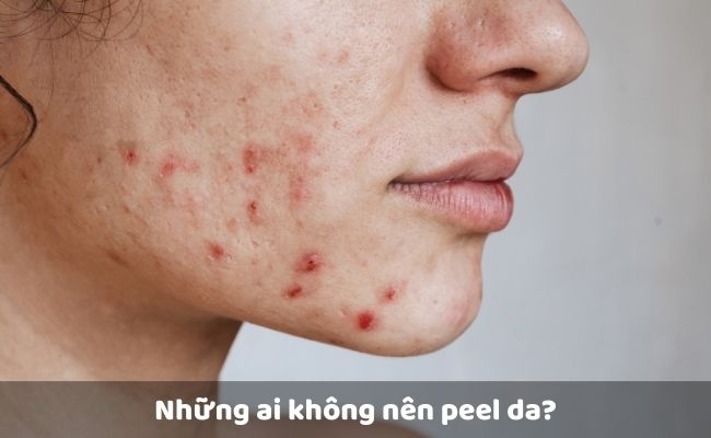Những ai không nên peel da?