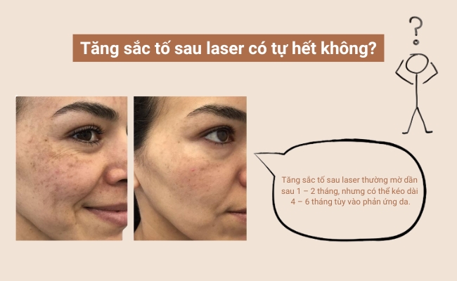 Tăng sắc tố da sau laser có thể tự hết sau vài tháng