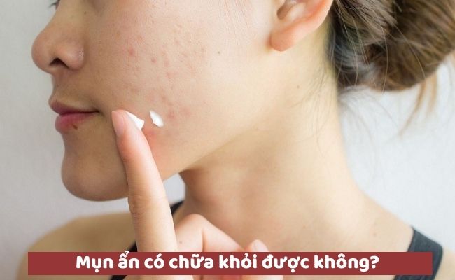 Mụn ẩn có chữa khỏi được không?
