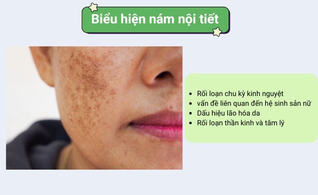 Biểu hiện nám nội tiết là gì