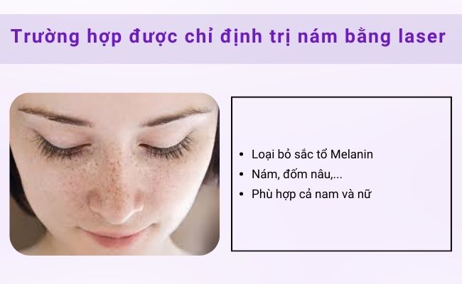 Trường hợp được chỉ định trị nám bằng laser