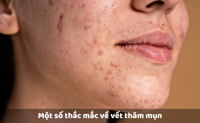 Một số thắc mắc về vết thâm mụn