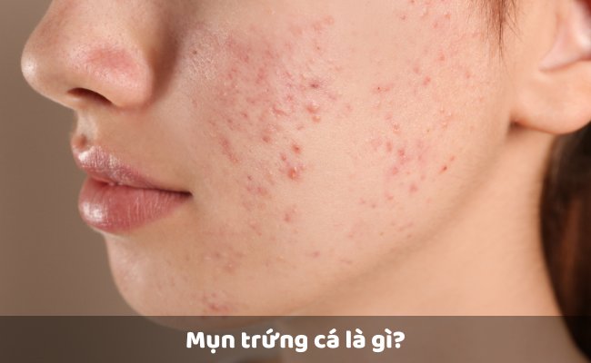 Mụn trứng cá là gì? Dấu hiệu nhận biết mụn trứng cá